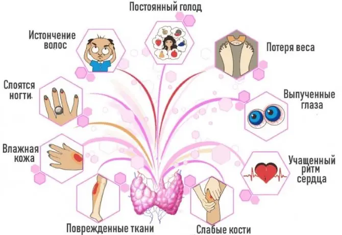 Симптомы гипертиреоза, добавки при заболевании